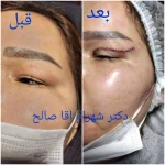 نمونه درمانی بلفاروپیلاستی(جراحی پشت پلک) دکتر شهرام آقاصالحه