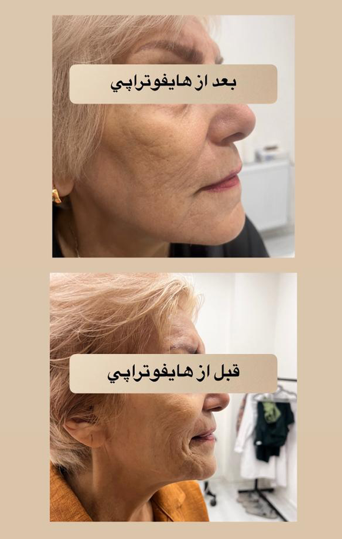 هایفوتراپی در اصفهان|دکتر شهرام آقا صالحه
