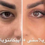 نمونه درمانی بلفاروپیلاستی(جراحی پشت پلک) دکتر شهرام آقاصالحه