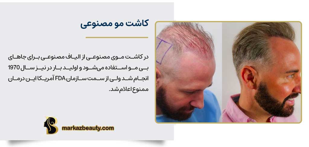 کاشت مو مصنوعی