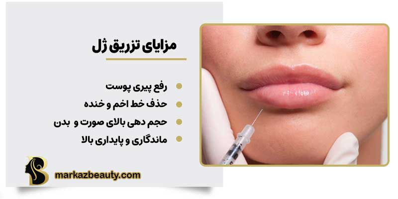 مزایای تزریق ژل