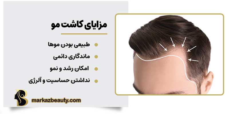 مزایای کاشت مو