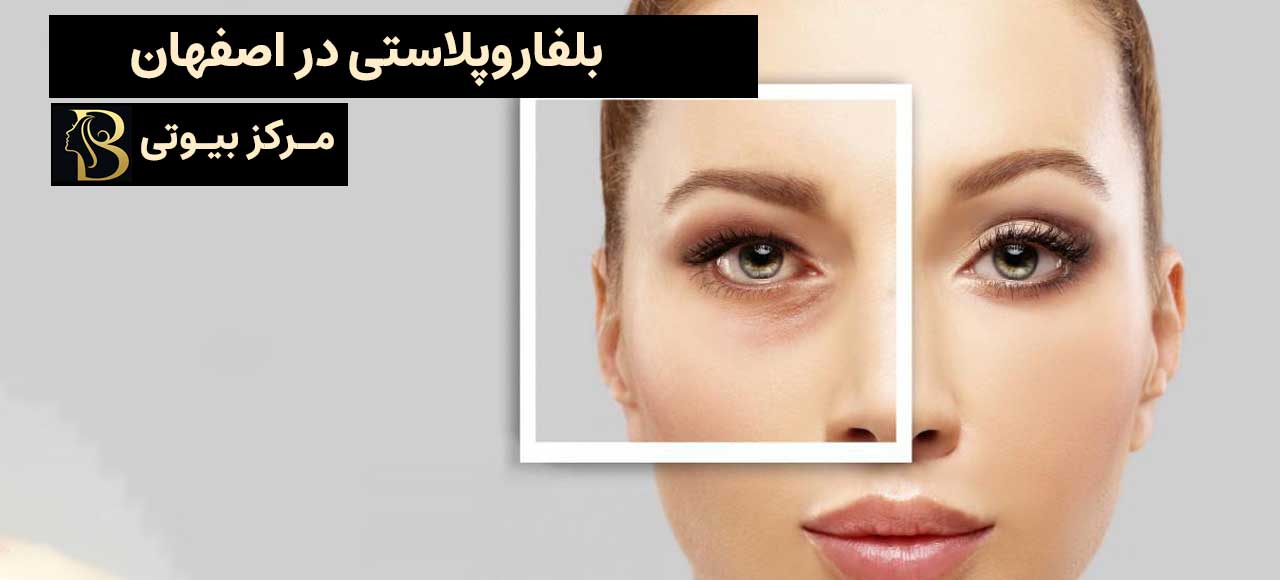 بلفاروپلاستی در اصفهان