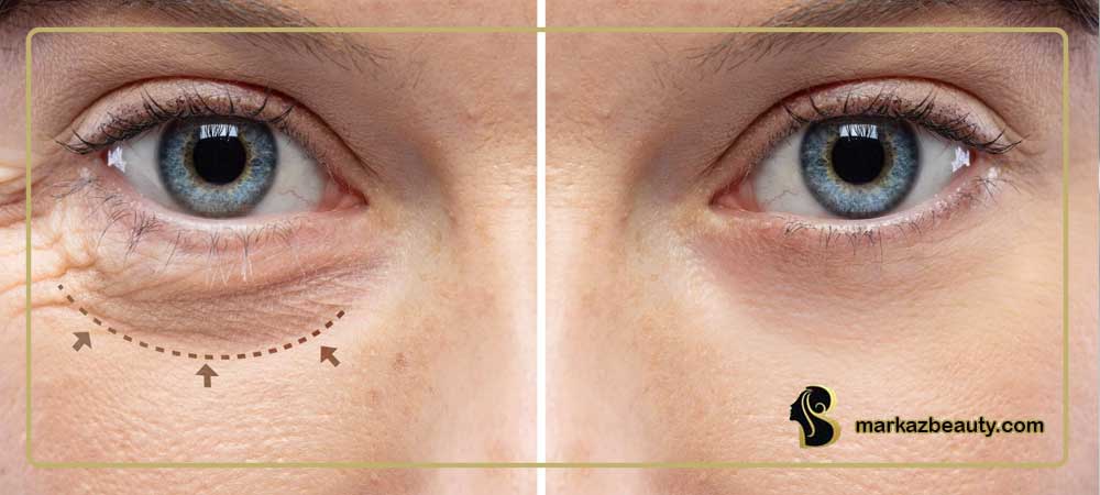 بلفاروپلاستی(Blepharoplasty) چیست؟