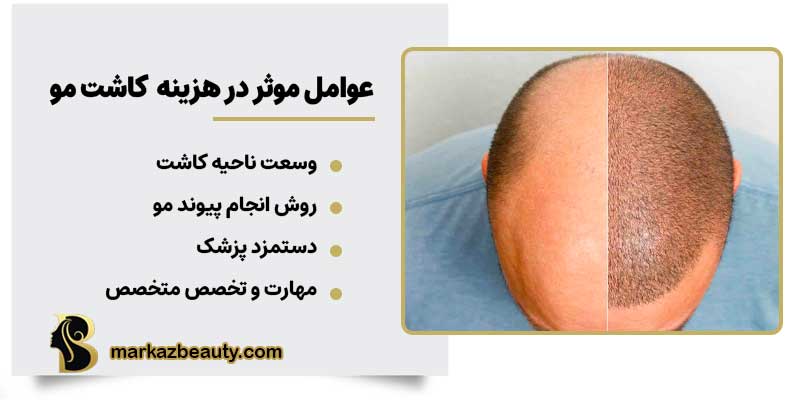 عوامل موثر در هزینه پیوند مو