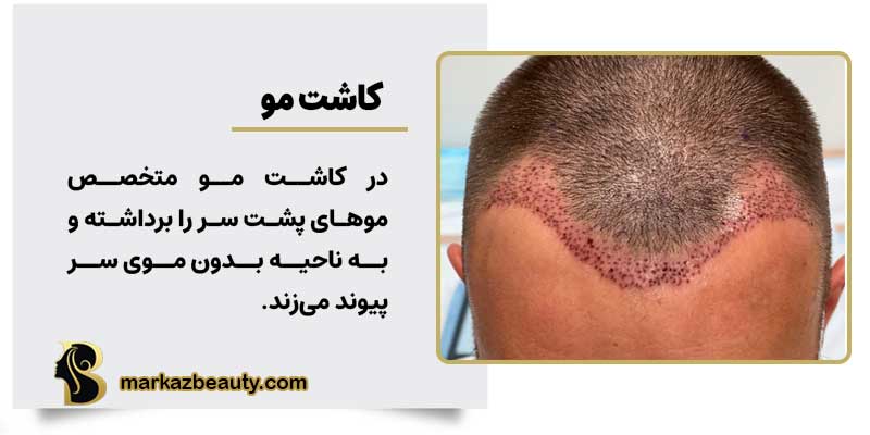 روش کاشت و پیوند مو