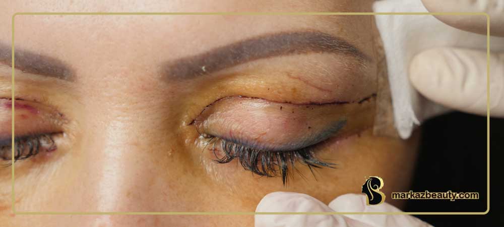 جراحی زیبایی پلک یا بلفاروپلاستی چگونه است؟