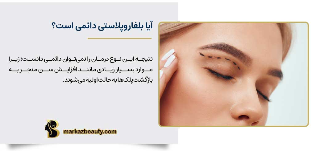 آیا بلفاروپلاستی دائمی است؟