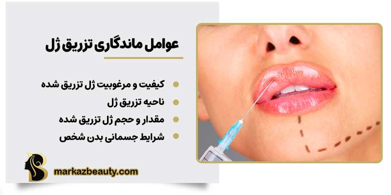 ماندگاری تزریق ژل