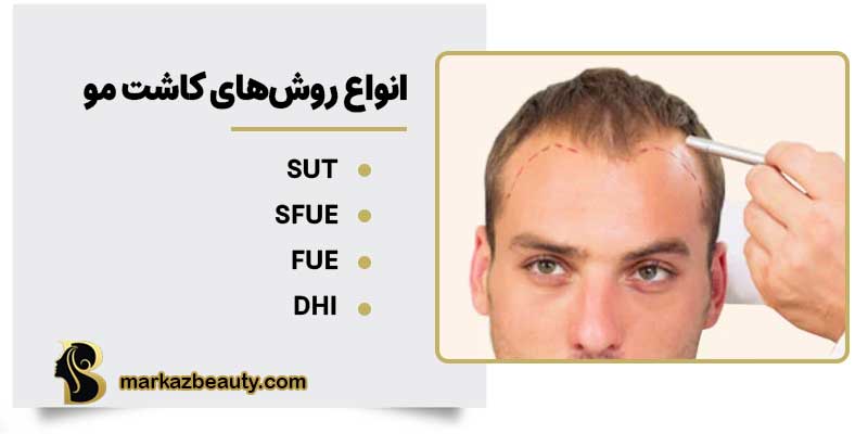 انواع روشهای کاشت مو
