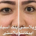نمونه درمانی بلفاروپیلاستی(جراحی پشت پلک) دکتر شهرام آقاصالحه