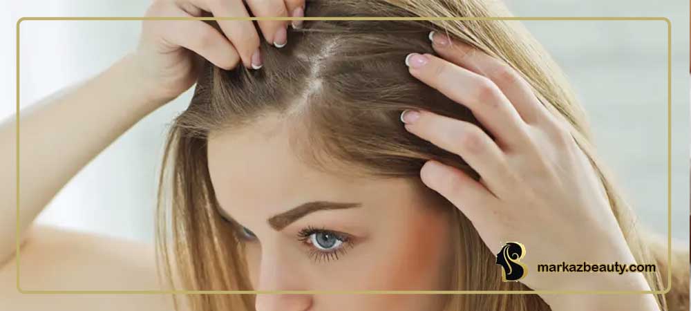 کاشت مو شقیقه خانم‌ها