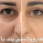 نمونه درمانی بلفاروپیلاستی(جراحی پشت پلک) دکتر شهرام آقاصالحه