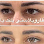 نمونه درمانی بلفاروپیلاستی(جراحی پشت پلک) دکتر شهرام آقاصالحه