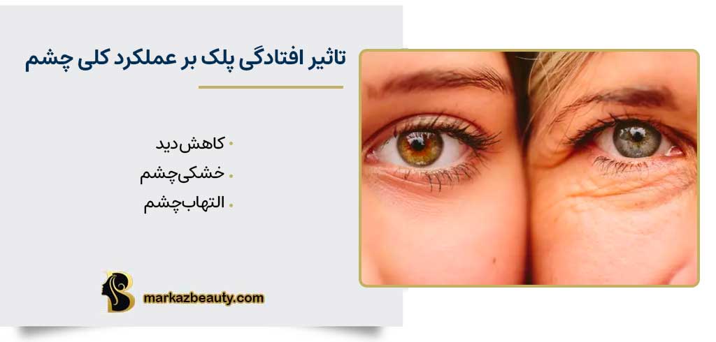 تاثیر افتادگی پلک بر عملکرد کلی چشم