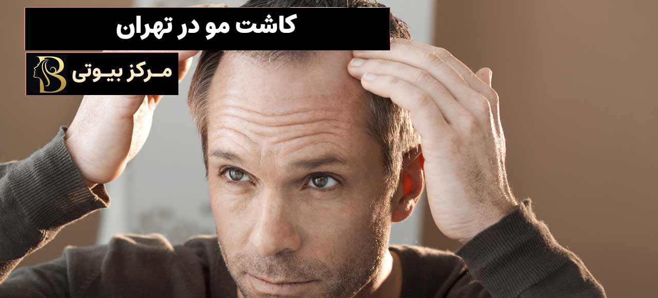 کاشت مو در تهران