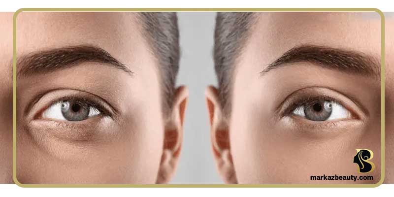 جراحی زیبایی پلک برای چه کسانی مناسب است؟