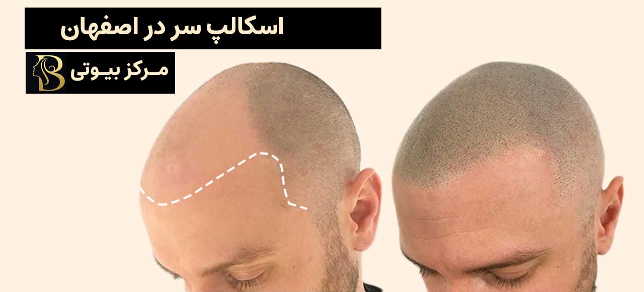 اسکالپ سر در اصفهان