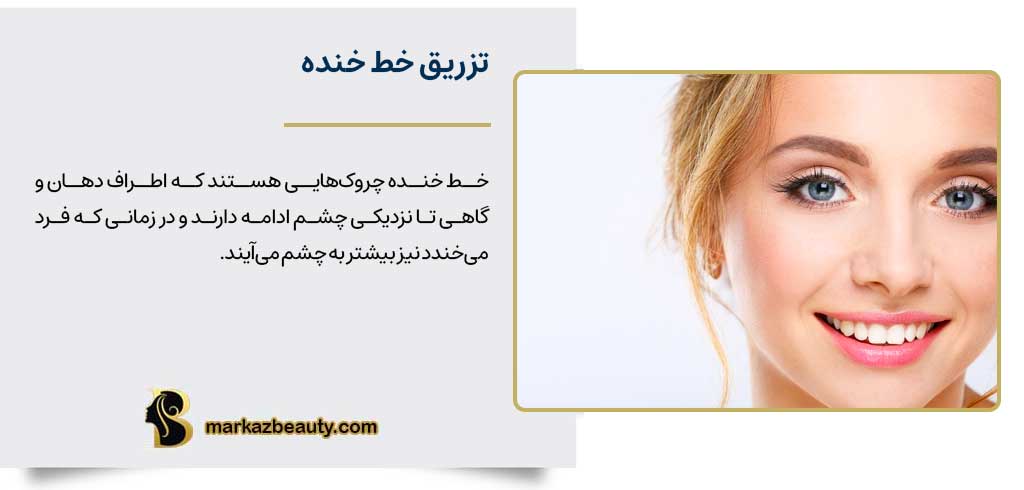 تزریق خط خنده