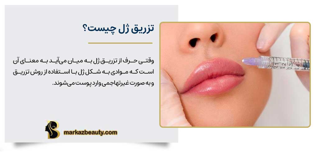 تزریق ژل چیست؟