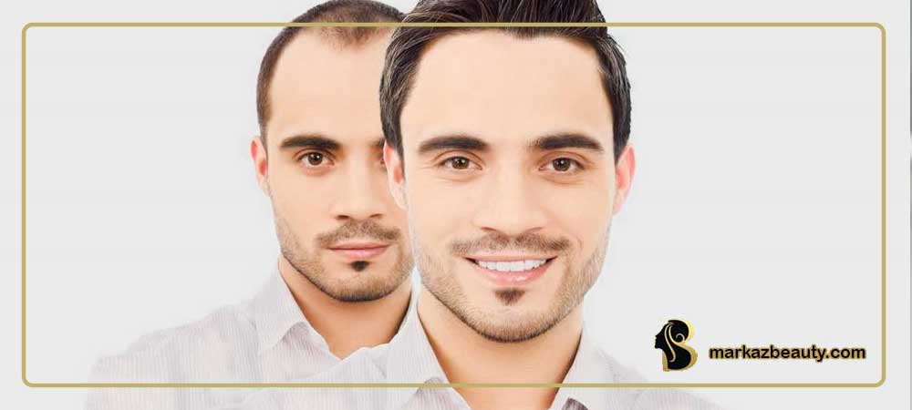 کاشت مو(Hair transplantation) چیست؟