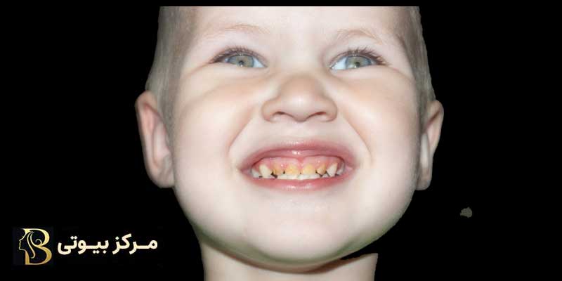 علت تغییر رنگ دندان کودکان چیست؟