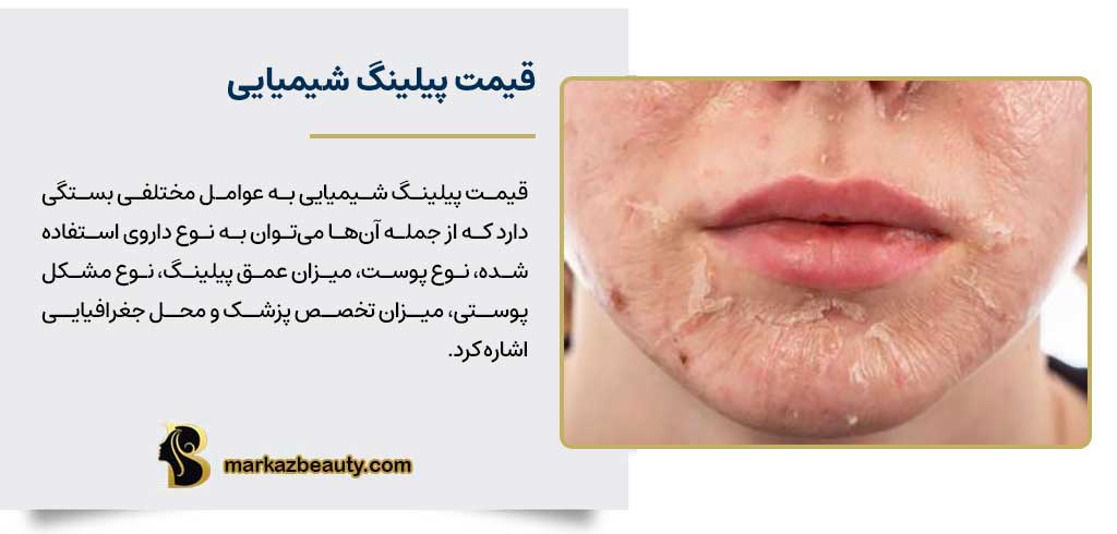 قیمت پیلینگ شیمیایی در اصفهان