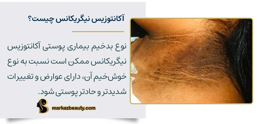 آکانتوزیس نیگریکانس چیست؟
