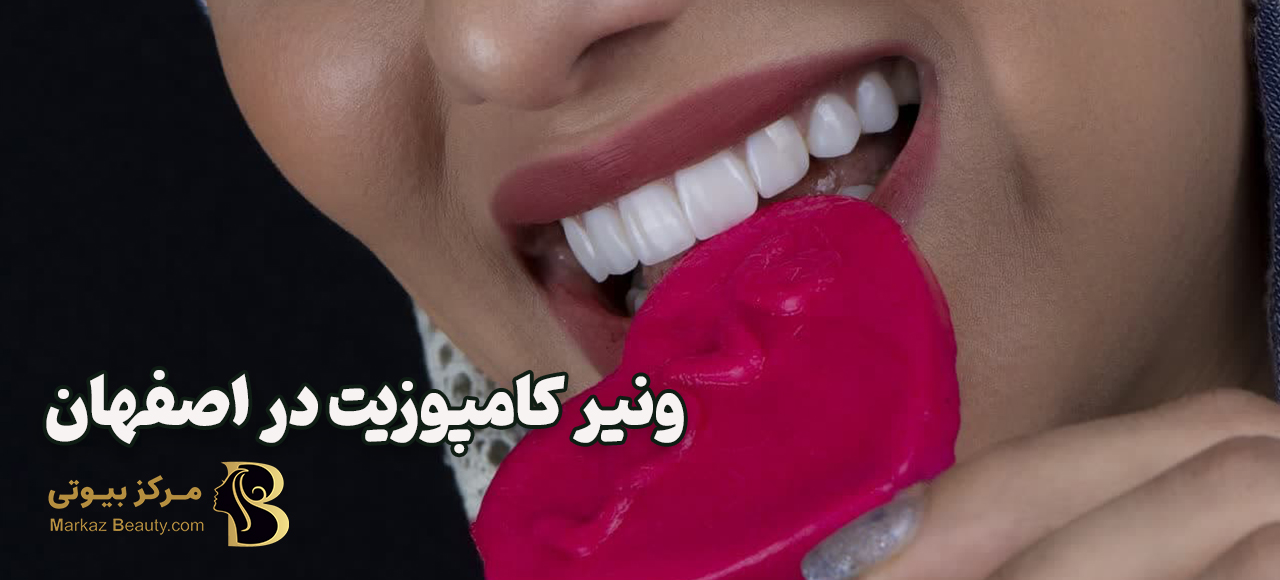 بهترین متخصص ونیر کامپوزیت در اصفهان