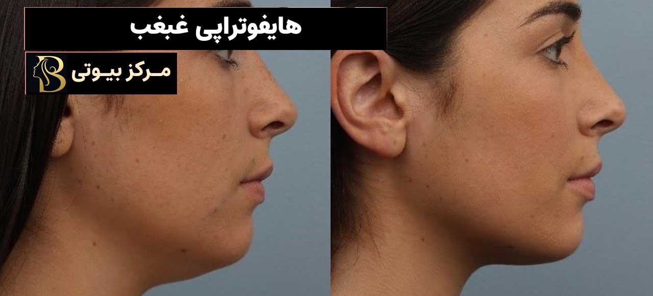 هایفوتراپی غبغب