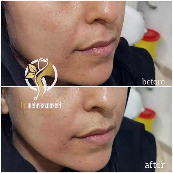 تزریق ژل لب در شاهین شهر | دکتر مهرناز ناظری