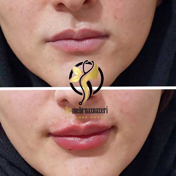 تزریق ژل لب در شاهین شهر | دکتر مهرناز ناظری