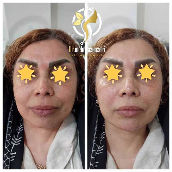تزریق فیلر در شاهین شهر | دکتر مهرناز ناظری