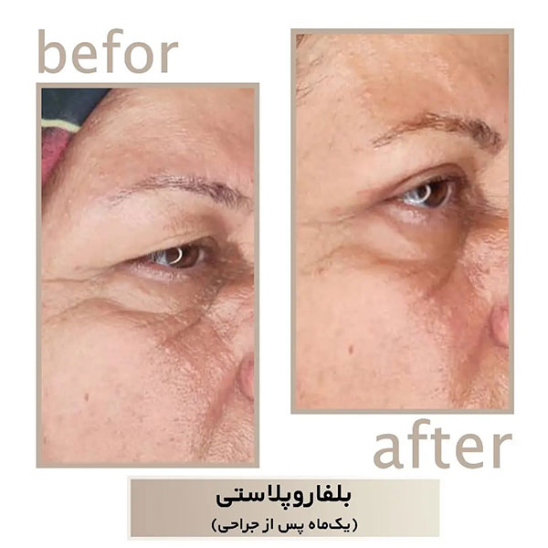 بلفاروپلاستی در شاهین شهر | دکتر سپیده سعادتی