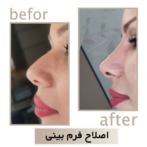 تزریق ژل در شاهین شهر | اندولیفت در شاهین شهر | دکتر سپیده سعادتی