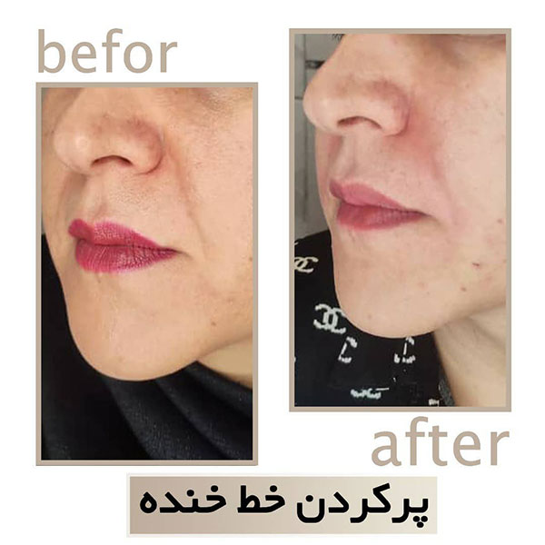 تزریق ژل در شاهین شهر | اندولیفت در شاهین شهر | دکتر سپیده سعادتی
