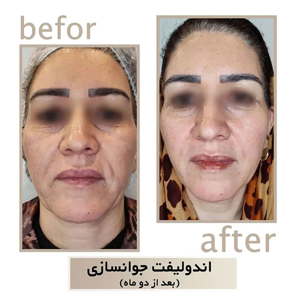 اندولیفت در شاهین | دکتر سپیده سعادتی