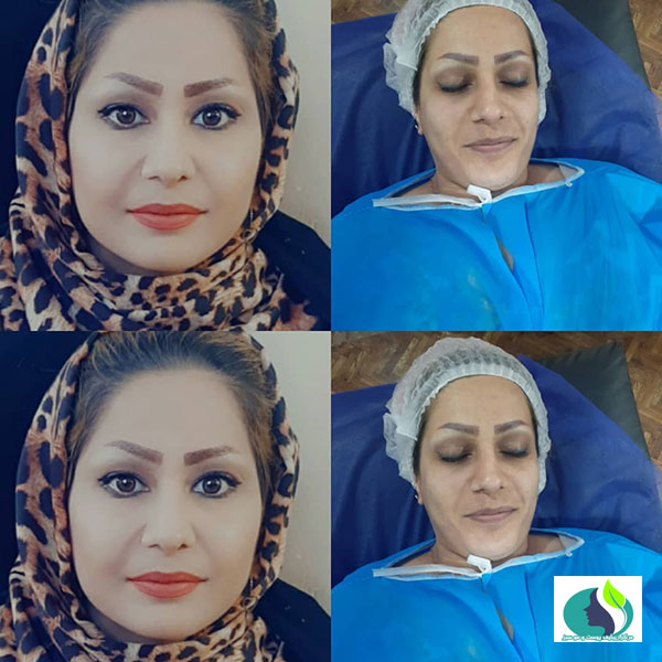 تزریق چربی در شاهین شهر | کلینیک پوست و مو سبز