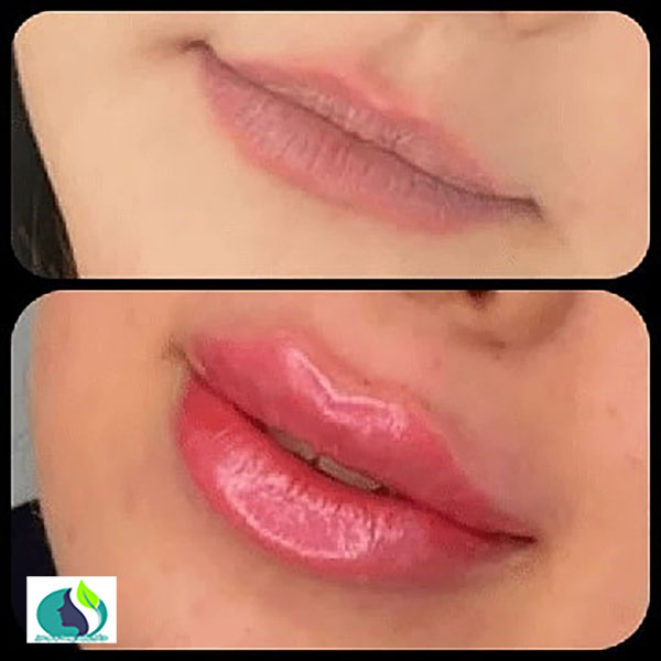 تزریق ژل لب در شاهین شهر | کلینیک پوست و مو سبز