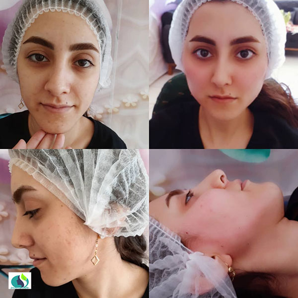 تزریق چربی در شاهین شهر | کلینیک پوست و مو سبز