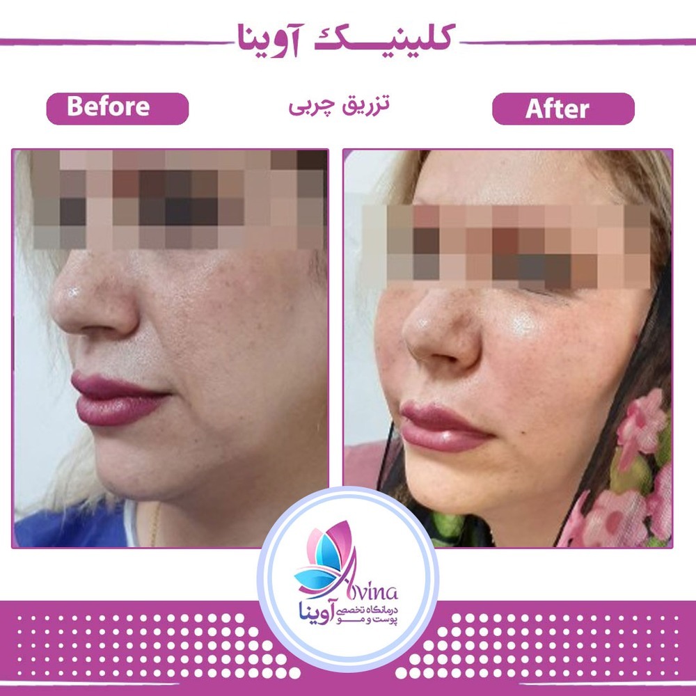 کلینیک تخصصی آوینا بهترین کلینیک کربوکسی تراپی| بهترین مرکز کربوکسی تراپی در تهران