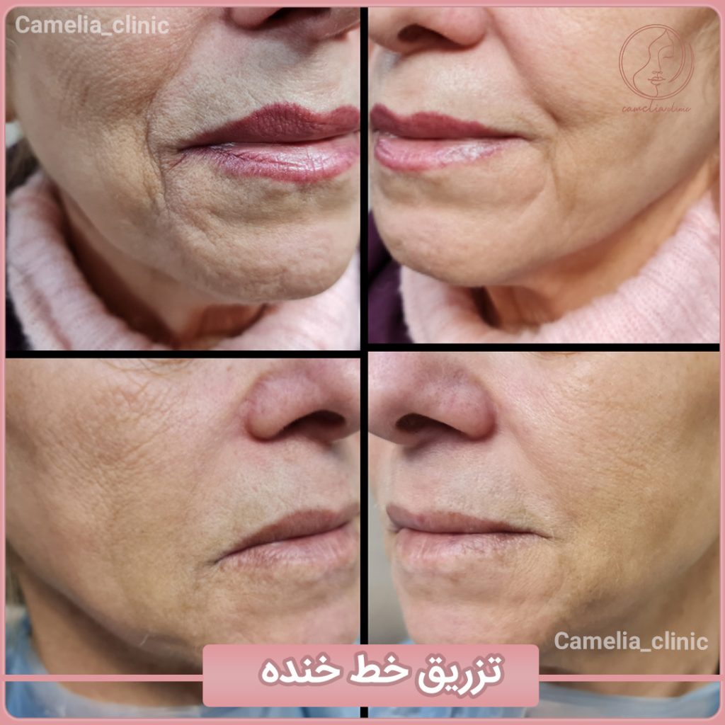 مرکز کاملیا بهترین کلینیک پیلینگ در کرج |بهترین مرکز پیلینگ در کرج