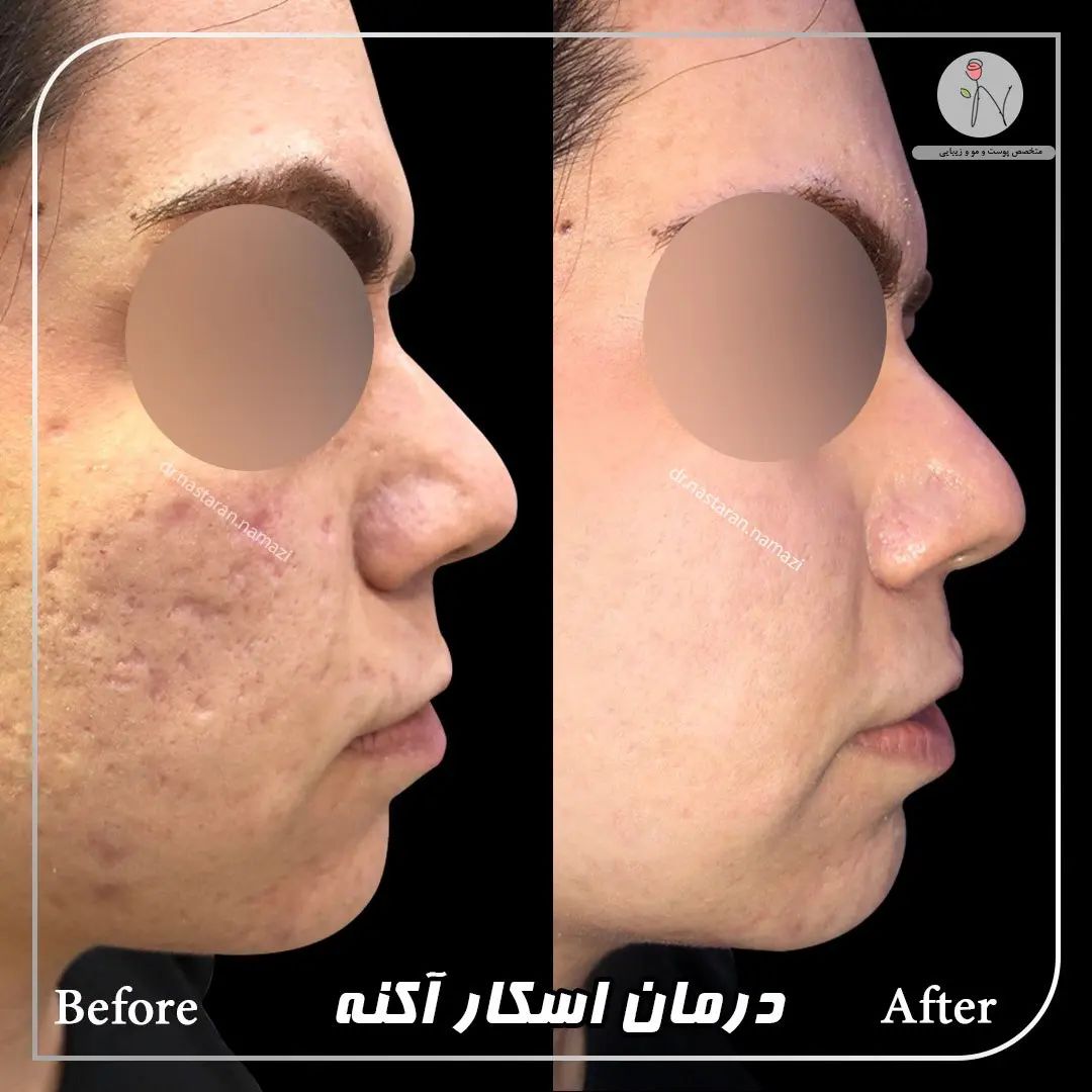دکتر نسترن نمازی بهترین متخصص کربوکسی تراپی| بهترین دکتر کربوکسی تراپی در تهران
