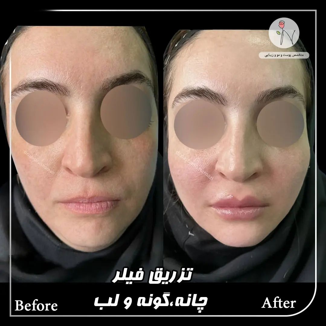 دکتر نسترن نمازی بهترین متخصص کربوکسی تراپی| بهترین متخصص کربوکسی تراپی در تهران