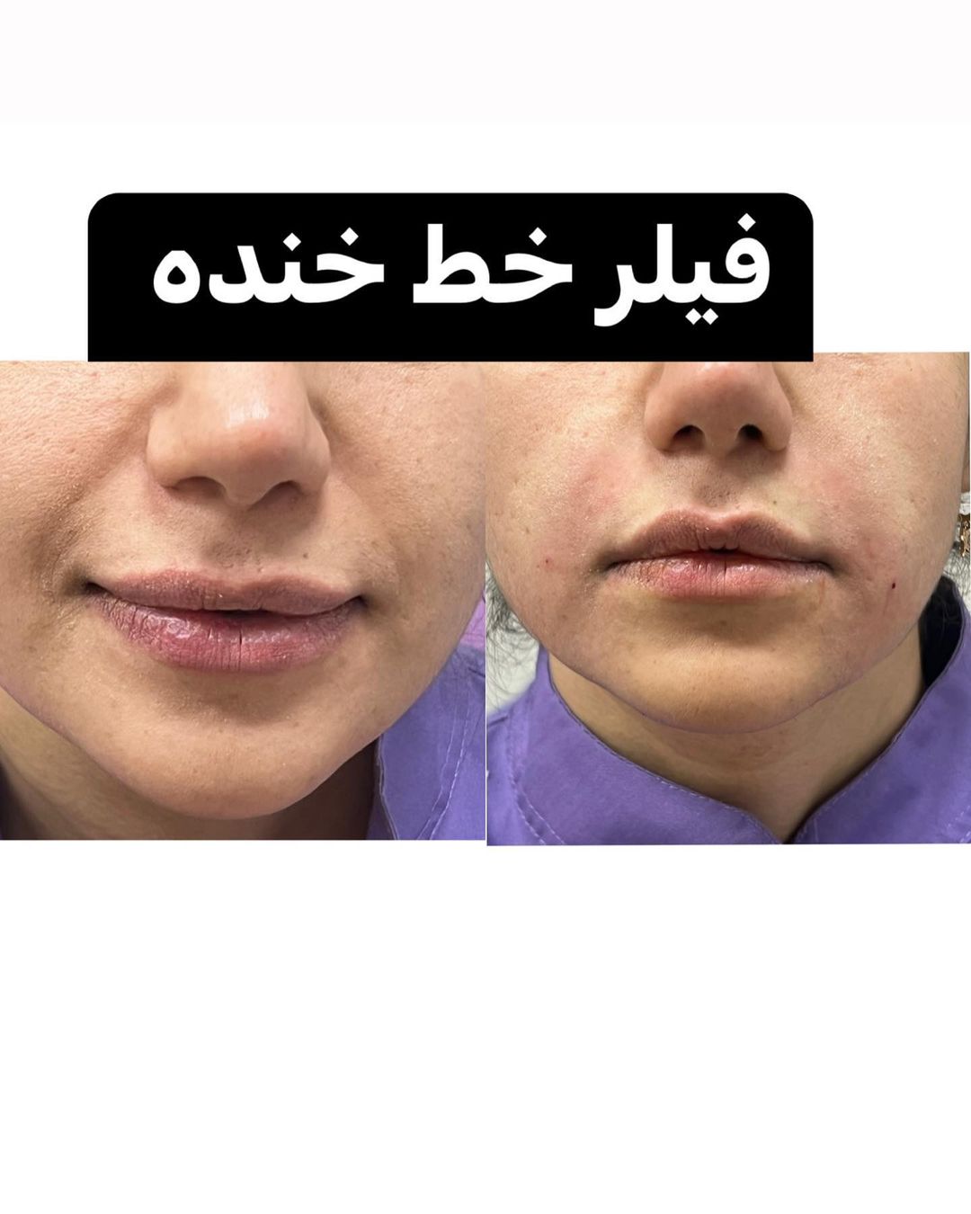 کلینیک تخصصی آوینا بهترین کلینیک کربوکسی تراپی| بهترین مرکز کربوکسی تراپی در تهران