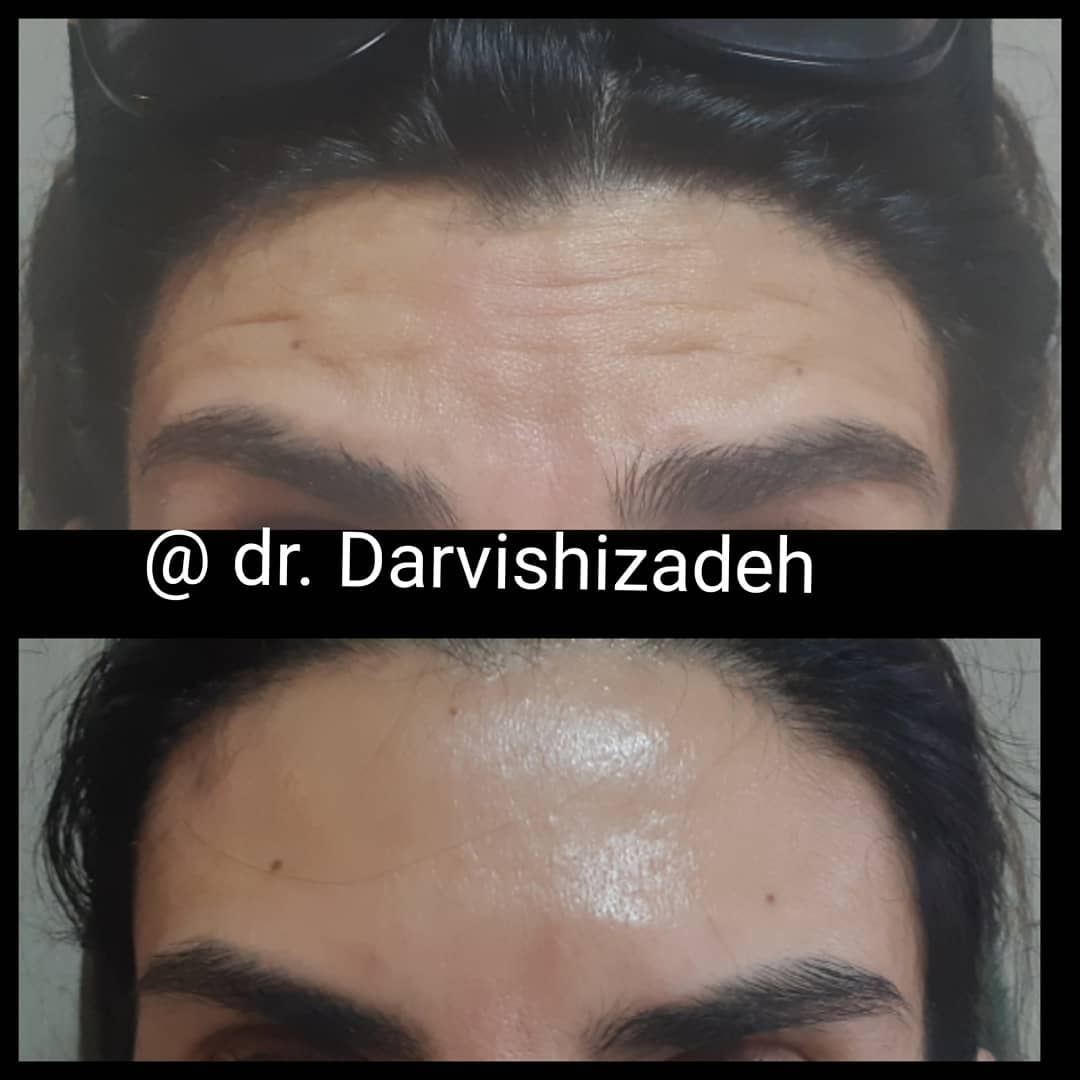 دکتر نادیا درویشی زاده متخصص میکرودرم| بهترین دکتر میکرودرم در تهران
