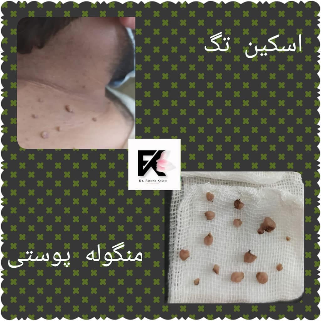 دکتر فرهاد کاوه بهترین متخصص کربوکسی تراپی در کرج| بهترین پزشک کربوکسی تراپی در کرج