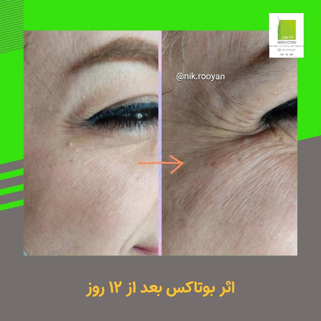 مرکز زیبایی نیک رویال در کرج | بهترین مرکز کربوکسی تراپی در کرج