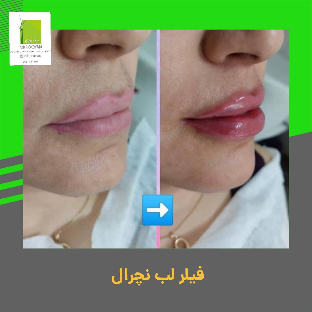 کلینیک تخصصی نیک رویال در کرج | بهترین کلینیک کربوکسی تراپی در کرج