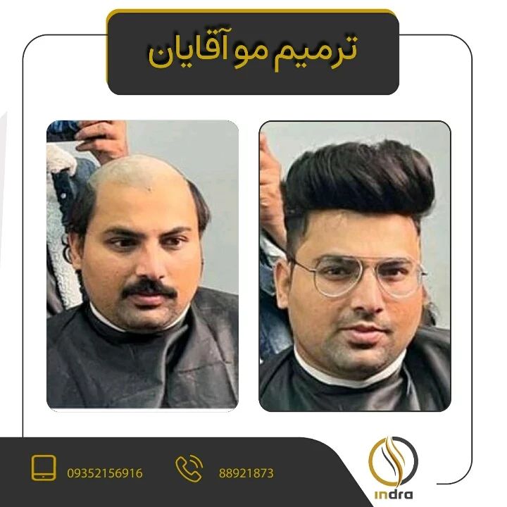 مرکز تخصصی اسکالپ سر ایندرا | بهترین کلینیک اسکالپ سر در تهران